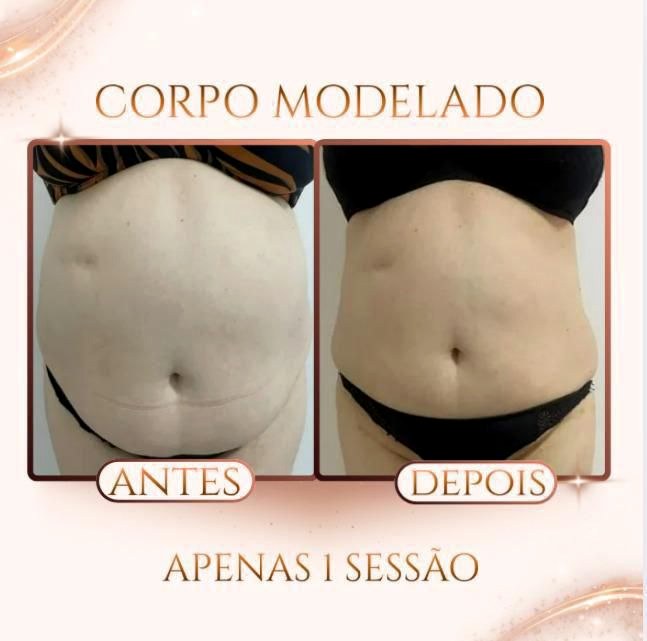 Antes e depois — Criolipólise na DDB Estética