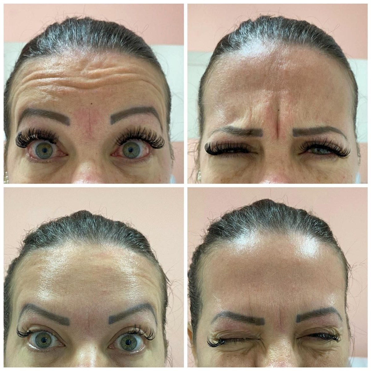 Antes e depois — aplicação de toxina botulínica para linhas de expressão