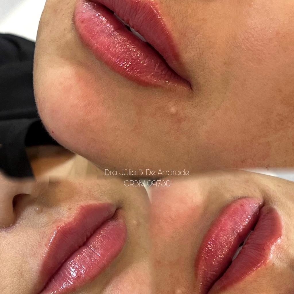 Antes e depois — preenchimento labial natural na DDB Estética