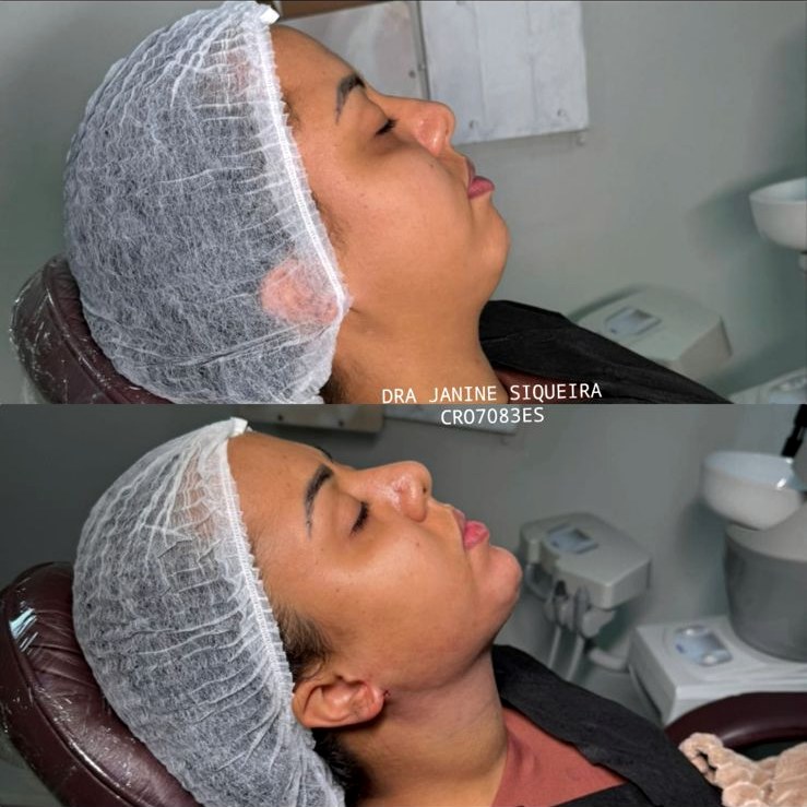 Antes e depois — tratamento de papada com resultado natural