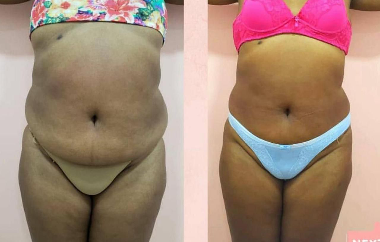Antes e depois — Criomodelagem corporal na DDB Estética