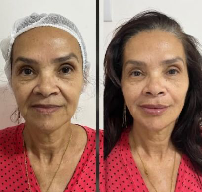 Antes e depois — Bioestimulador de colágeno Sculptra na DDB Estética